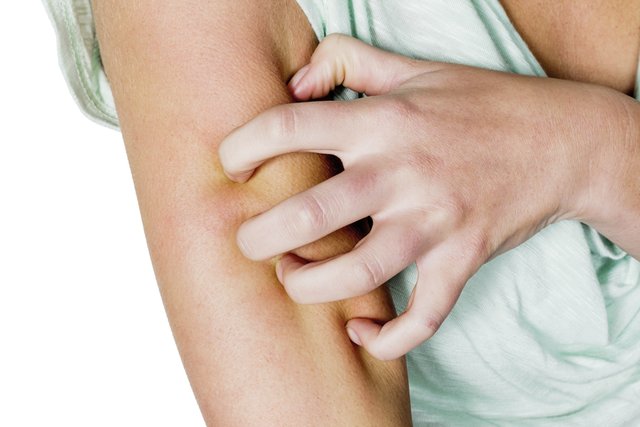 Durch Jucken und Kratzen entstehen oft langwierige Wunden. Auch hier bewährt sich eine hydroaktive, feuchthaltende Wundversorgung. | Foto: Gina Sanders/stock.adobe.com