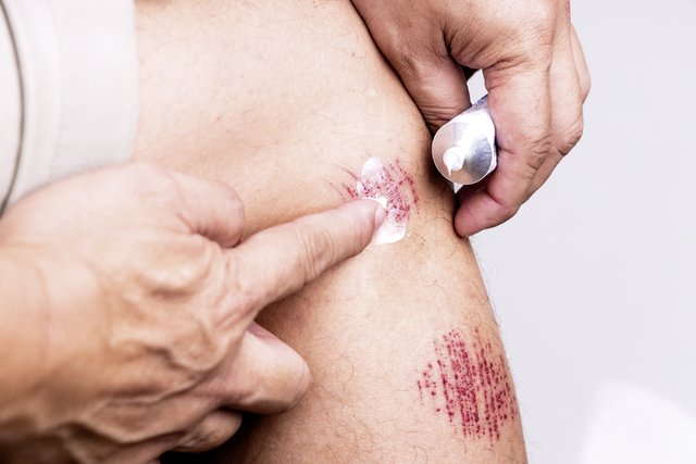 Die beste Wundheilung ist die feuchte Wundheilung. Hierfür bewährt sich ein modernes, luftdurchlässiges Wundgel mit Zink und Eisen, das zusätzlich den pH-Wert reguliert. | Foto: ThamKC/stock.adobe.com