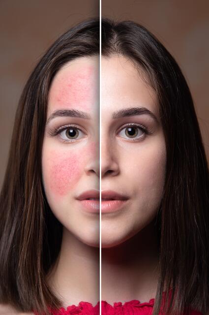 Rötungen ade: Mit einer konsequenten Therapie kann bei Rosacea oft Erscheinungsfreiheit erreicht werden. Foto: djd/rosacea-info.de/Alessandro Grandini - stock.adobe.com