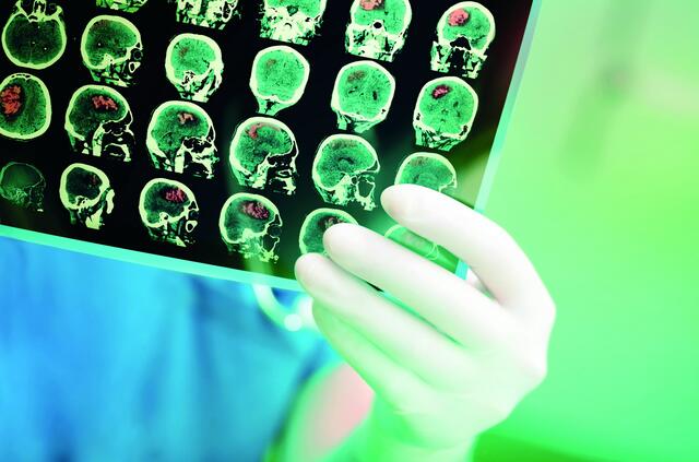 Welt-Hirntumor-Tag 2023. | Foto: sudok1_AdobeStock