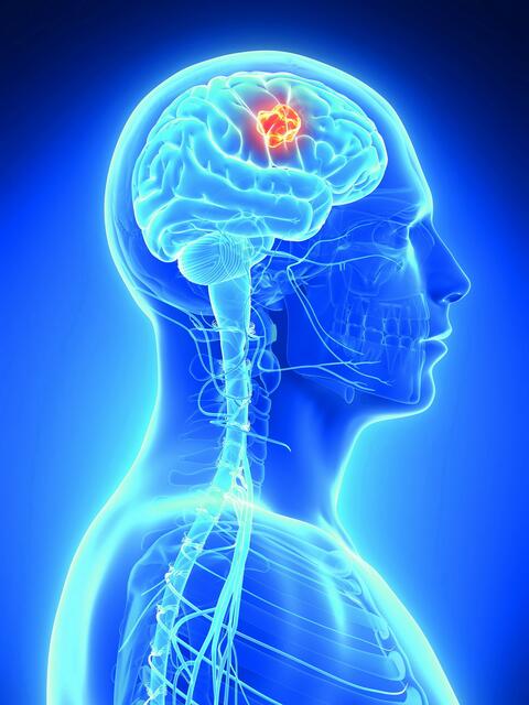 Welt-Hirntumor-Tag 2023. | Foto: Sebastian Kaulitzki - AdobeStock